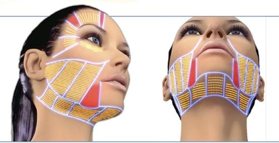 laser4_pic7