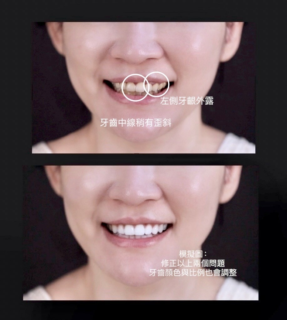 竹北牙齒美容推薦-真美舒眠植牙中心 專業美容牙科醫師-廖秦儀 微笑曲線,舒眠植牙, All on 4