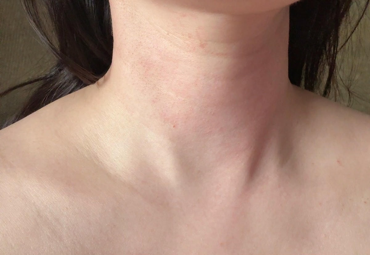 安妞美學診所天母店 精靈水光(閃電微針+精靈真肌(聚雙旋乳酸 安妞美學診所天母店 精靈水光(閃電微針+精靈真肌(聚雙旋乳酸