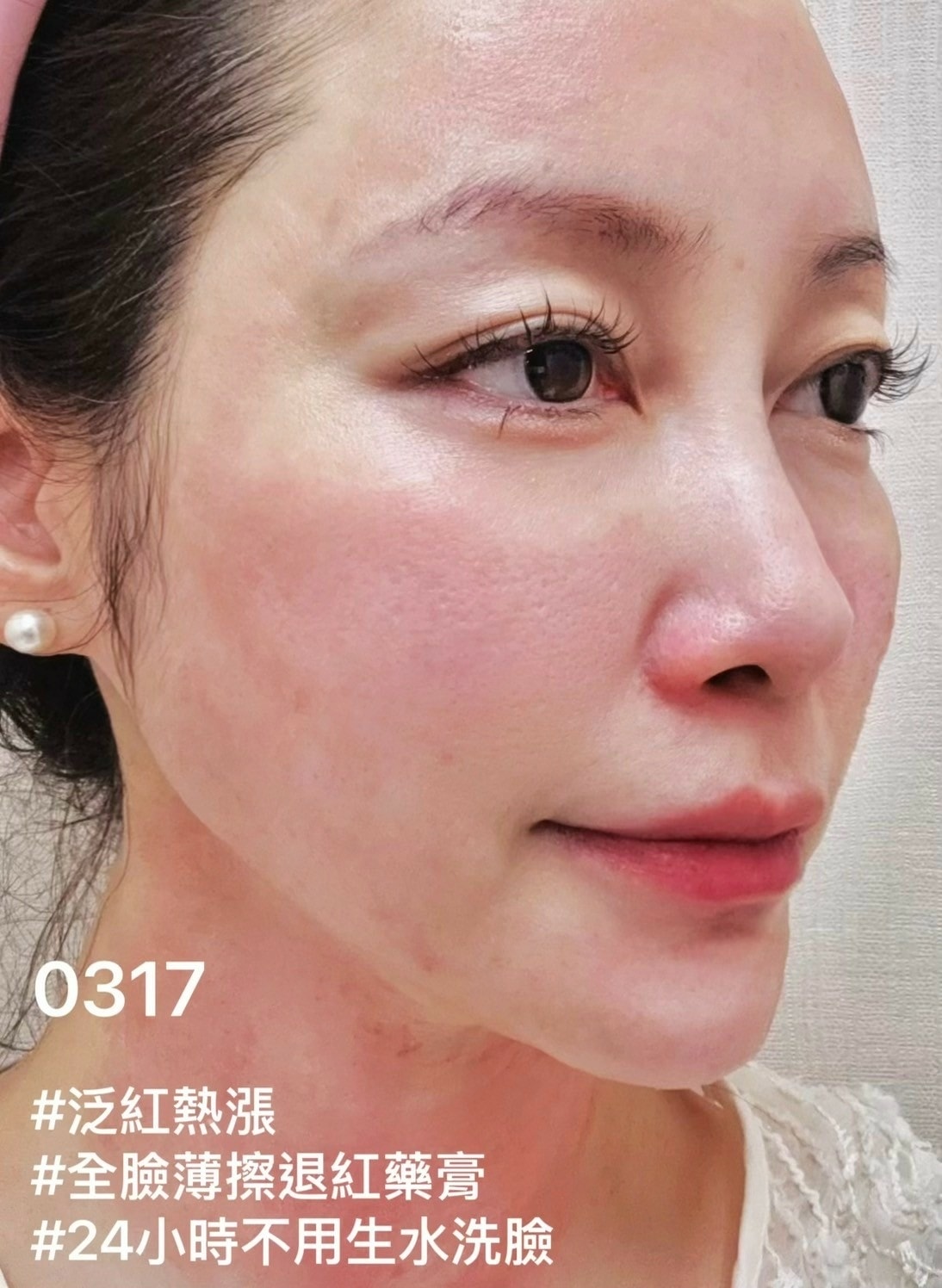 安妞美學診所天母店 精靈水光(閃電微針+精靈真肌(聚雙旋乳酸 安妞美學診所天母店 精靈水光(閃電微針+精靈真肌(聚雙旋乳酸